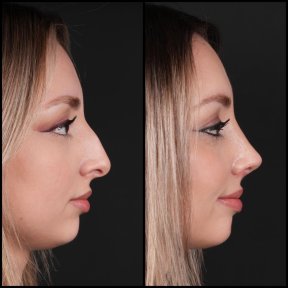 Premium Rhinoplasty (nose job) All Included - photo 5