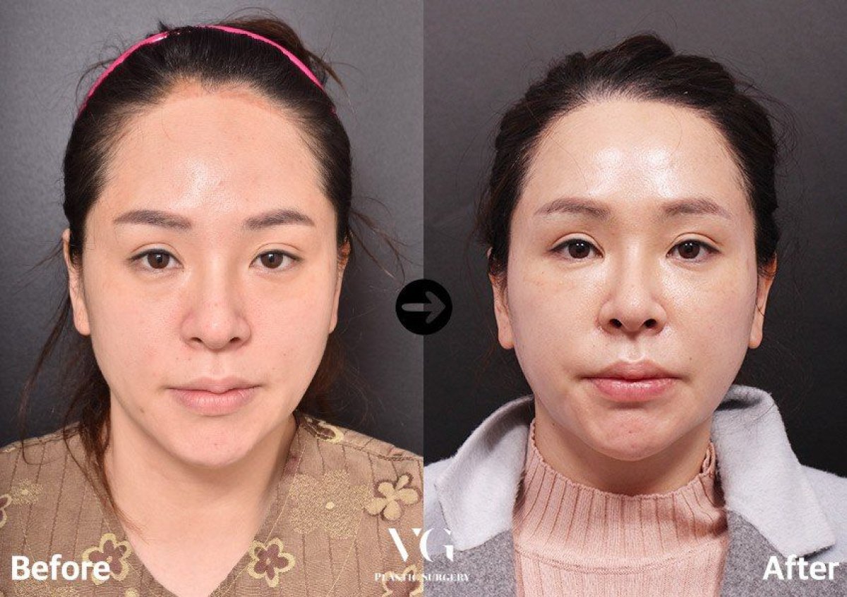 نتيجة قبل وبعد علاج تجديد الشباب بالخلايا الجذعية في VG Plastic Surgery، علاج مكافحة الشيخوخة