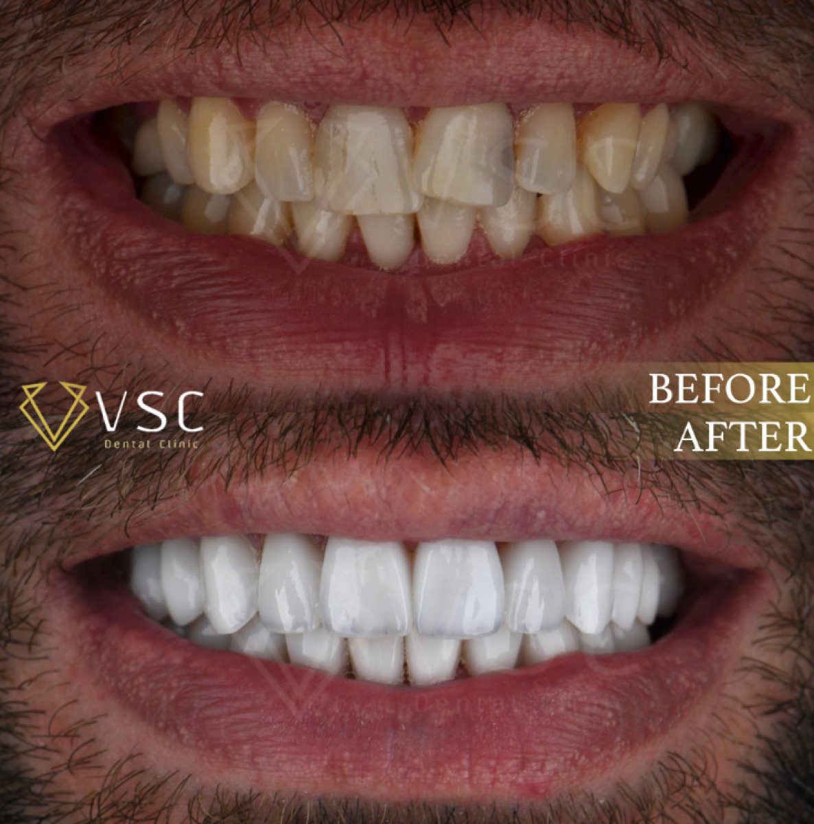 نتائج قبل وبعد الفينير في عيادة VSC – تحول الابتسامة بنتائج طبيعية