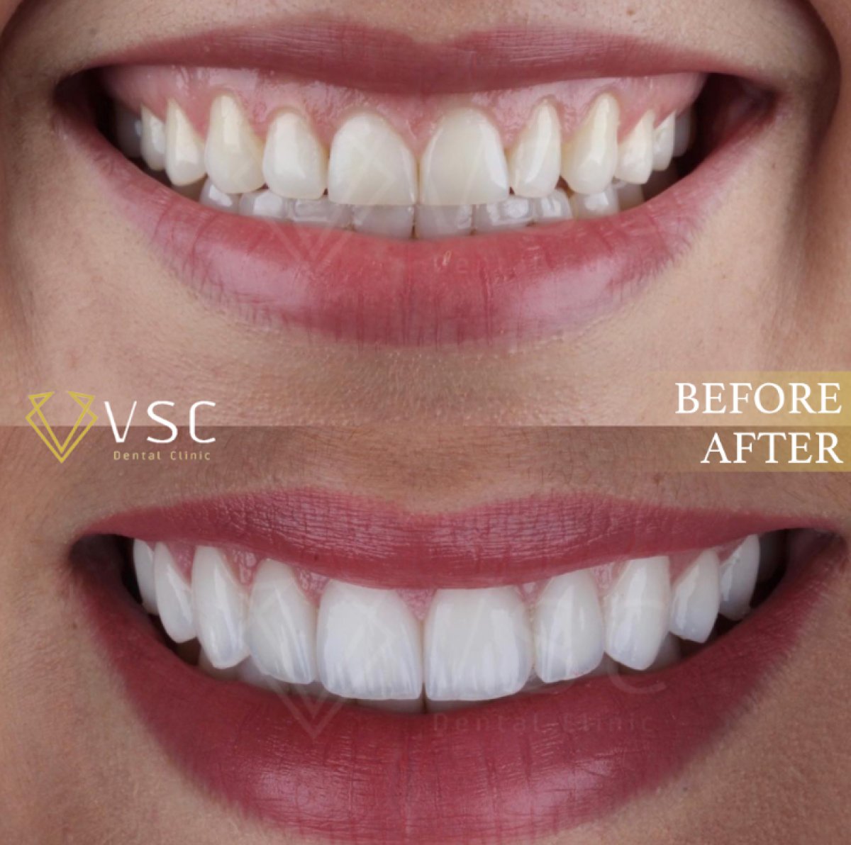 Antes y después de carillas dentales en VSC Dental Clinic – transformación de sonrisa natural