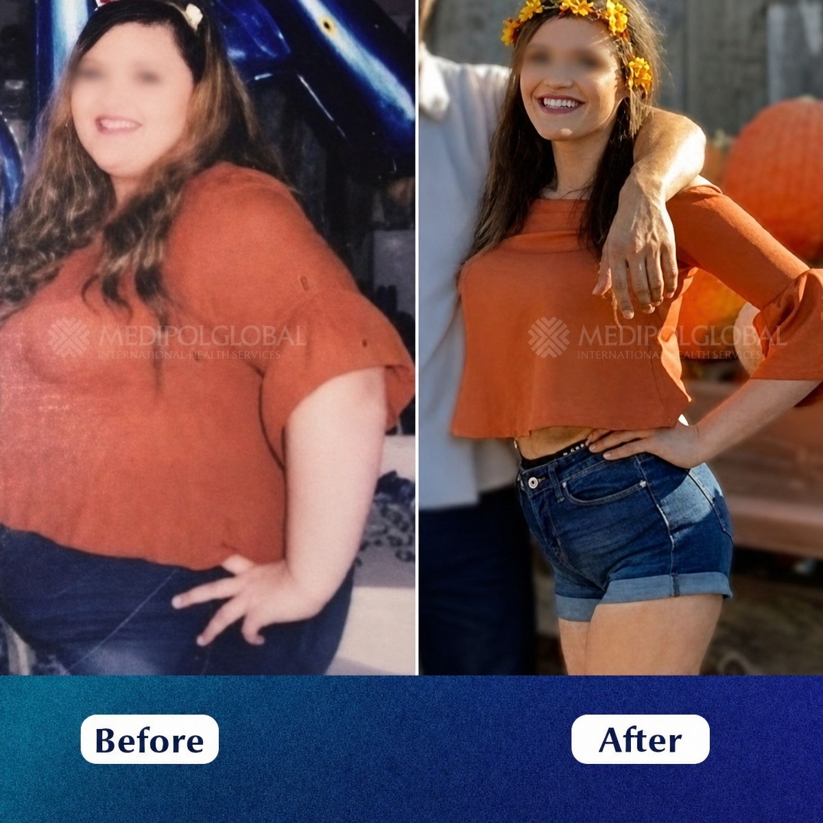 Before and after endoscopic sleeve gastroplasty at Medipol Acibadem District Hospital, weight loss result