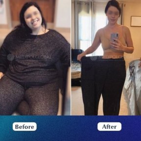 VIP Endoscopic Gastric Sleeve (ESG) – Scarless, Safe & Exclusive Weight Loss with Free FibroScan - photo 6