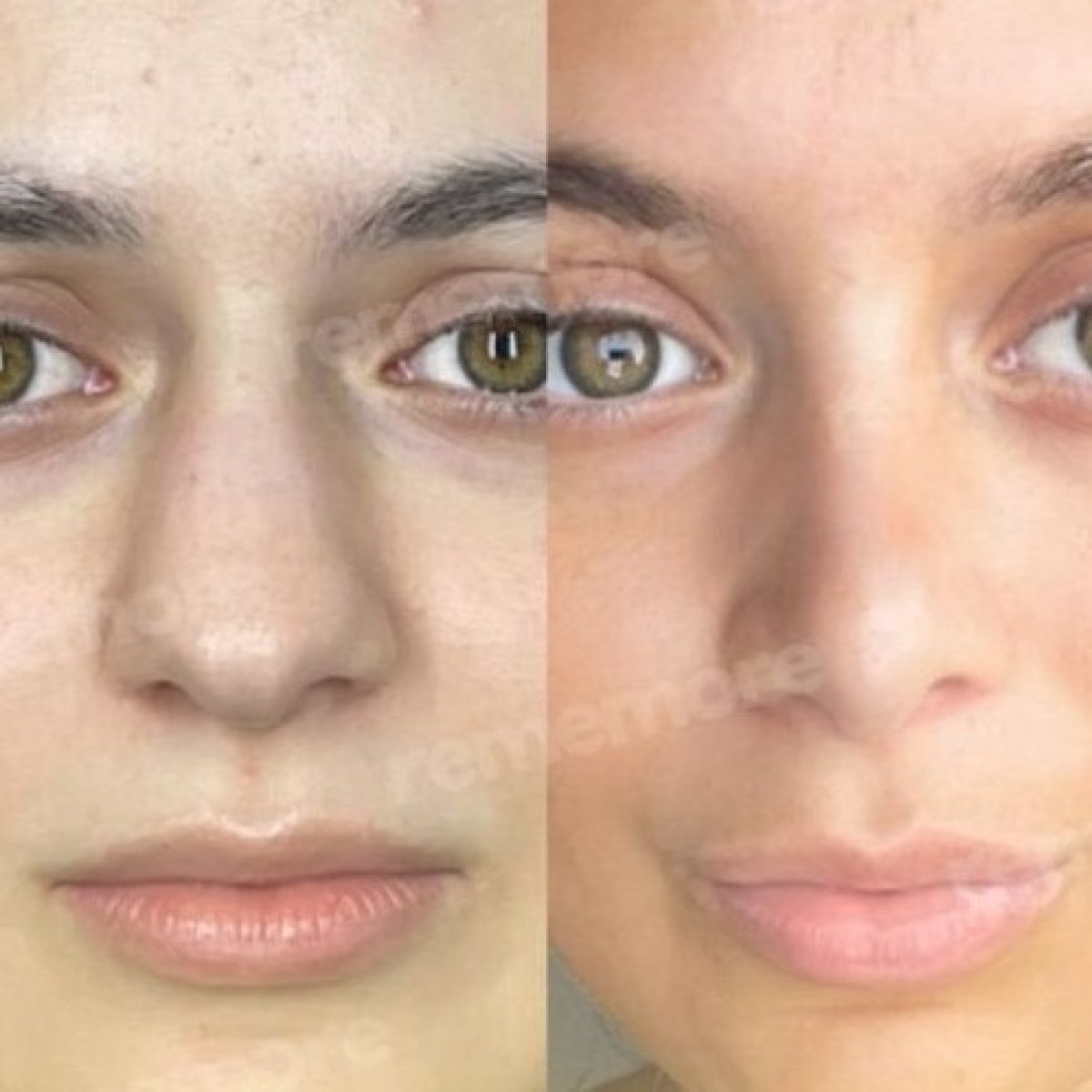 Resultados antes y después de rinoplastia de punta en Memorial Bahçelievler Hospital, nariz refinada