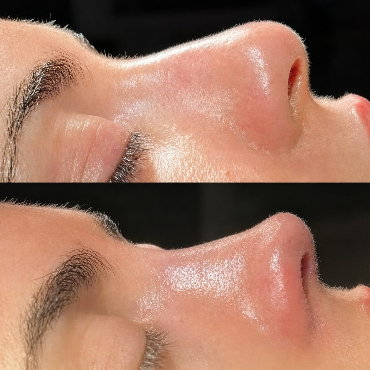Résultats avant/après rhinoplastie de la pointe au Memorial Bahçelievler Hospital, nez affiné