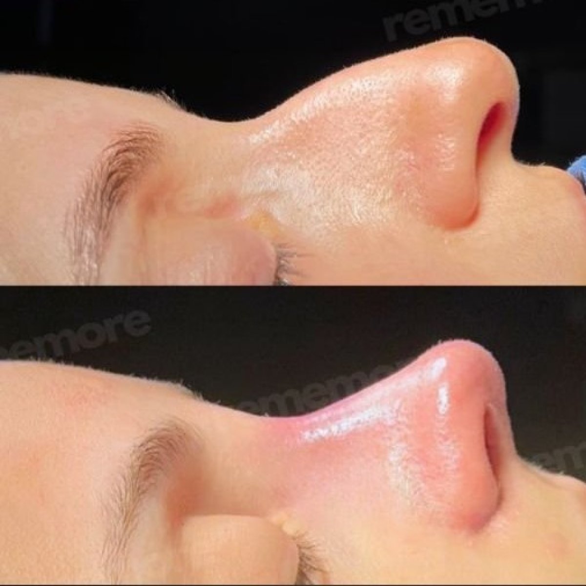 Before and after tip rhinoplasty results at Memorial Bahçelievler Hospital, refined nose shape