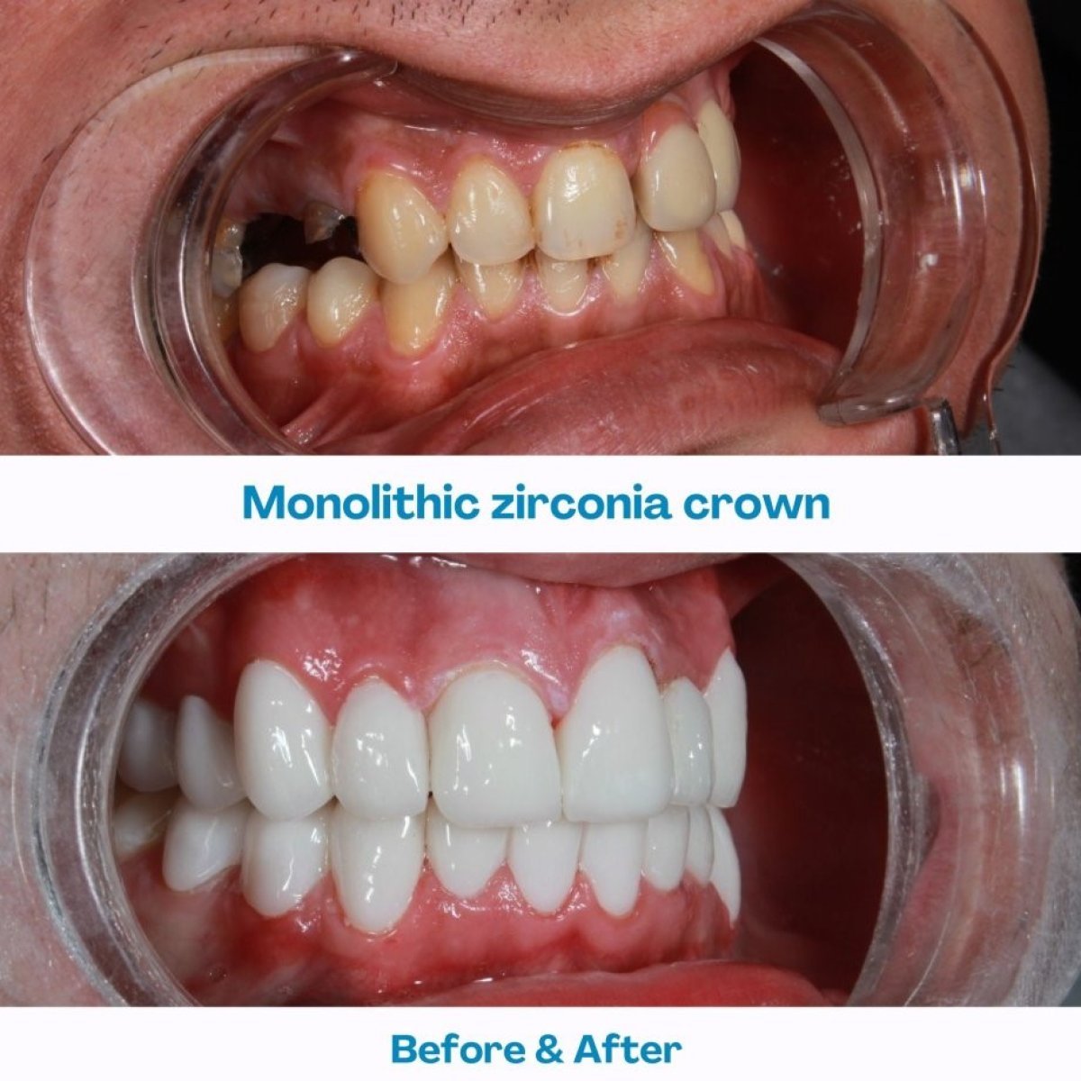 نتائج قبل وبعد تيجان الزركونيا الأحادية في مستشفى İstinye Dental، تجميل الابتسامة