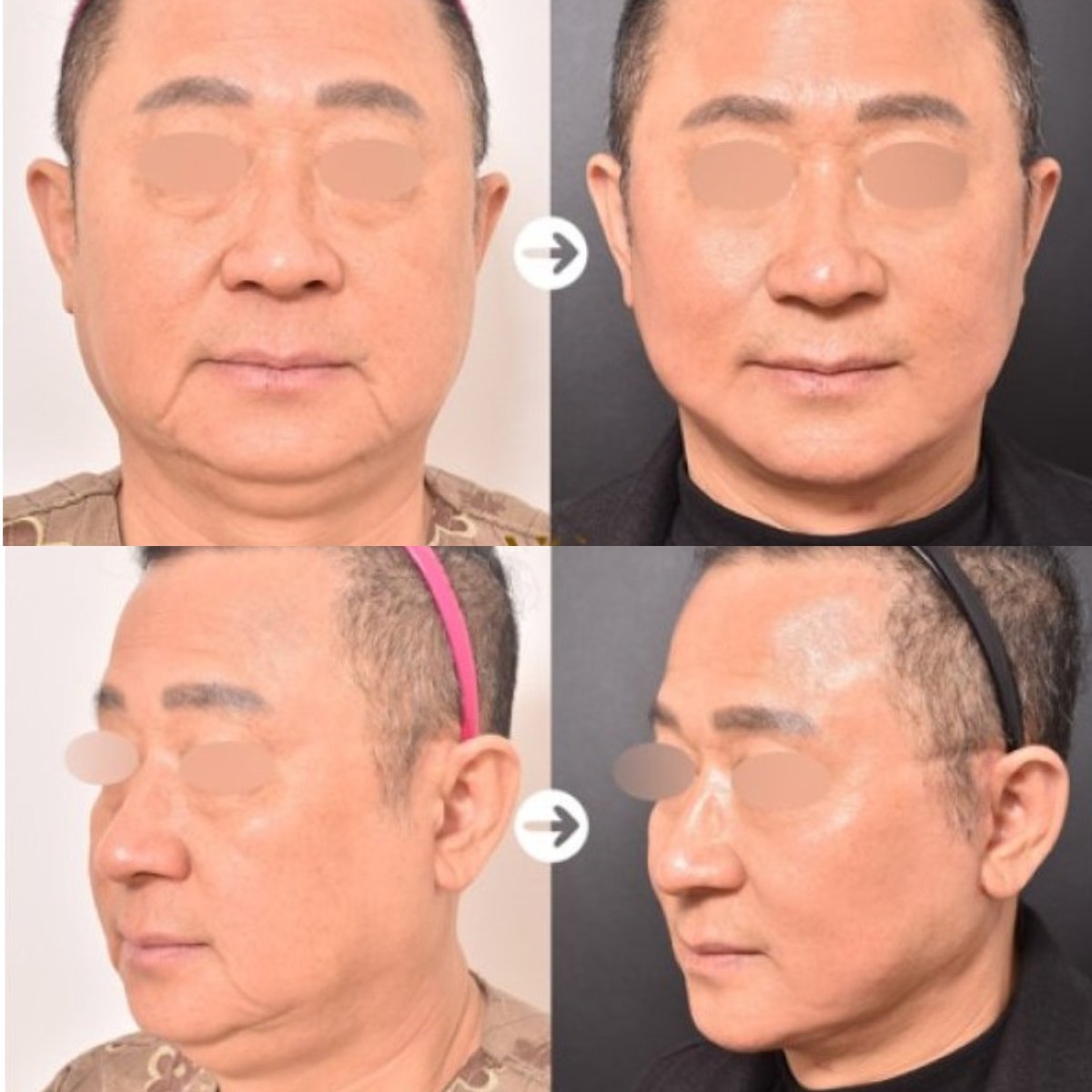 Before and after mini facelift results at VG Plastic Surgery, visible facial rejuvenation