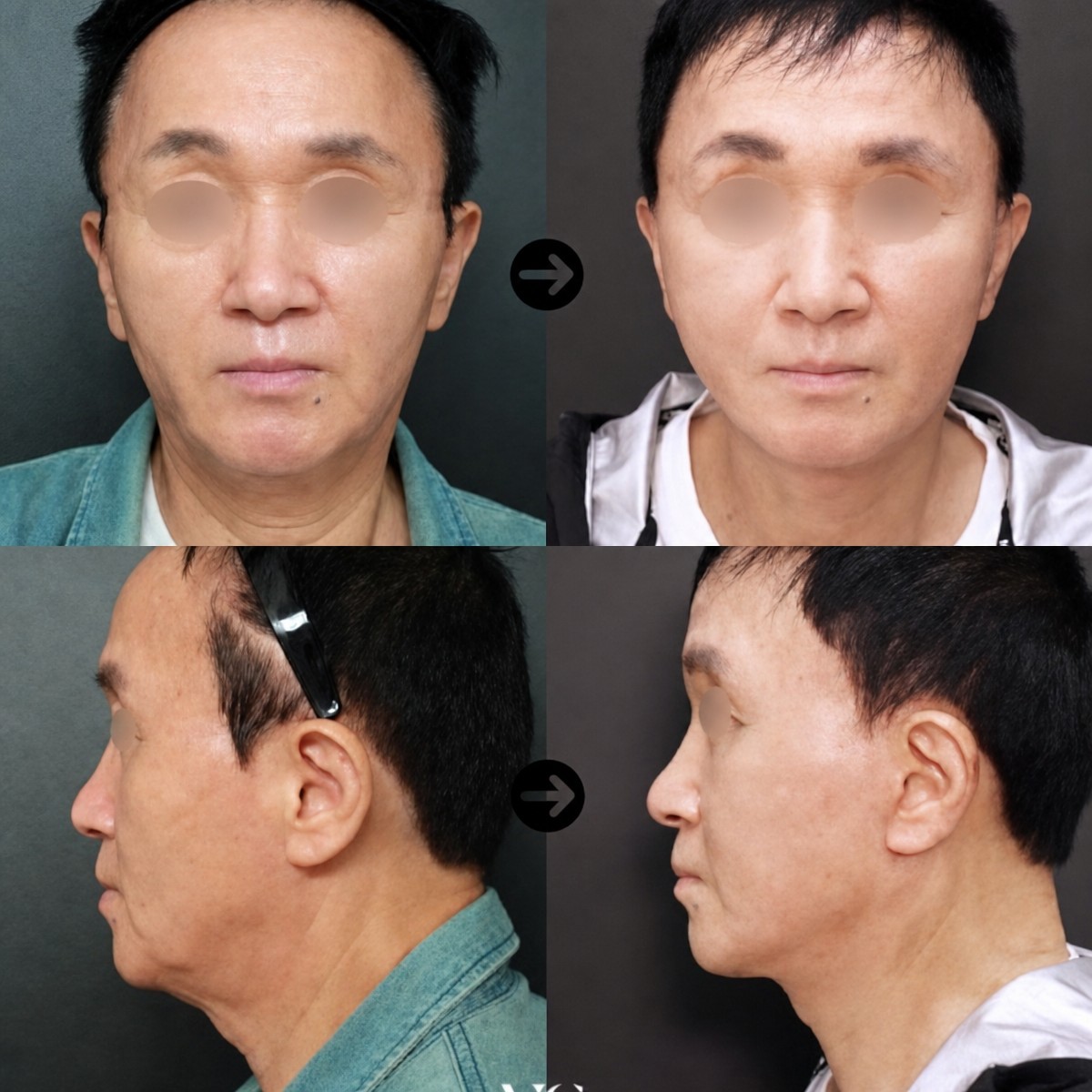 Résultats avant/après mini lifting du visage chez VG Plastic Surgery, rajeunissement visible