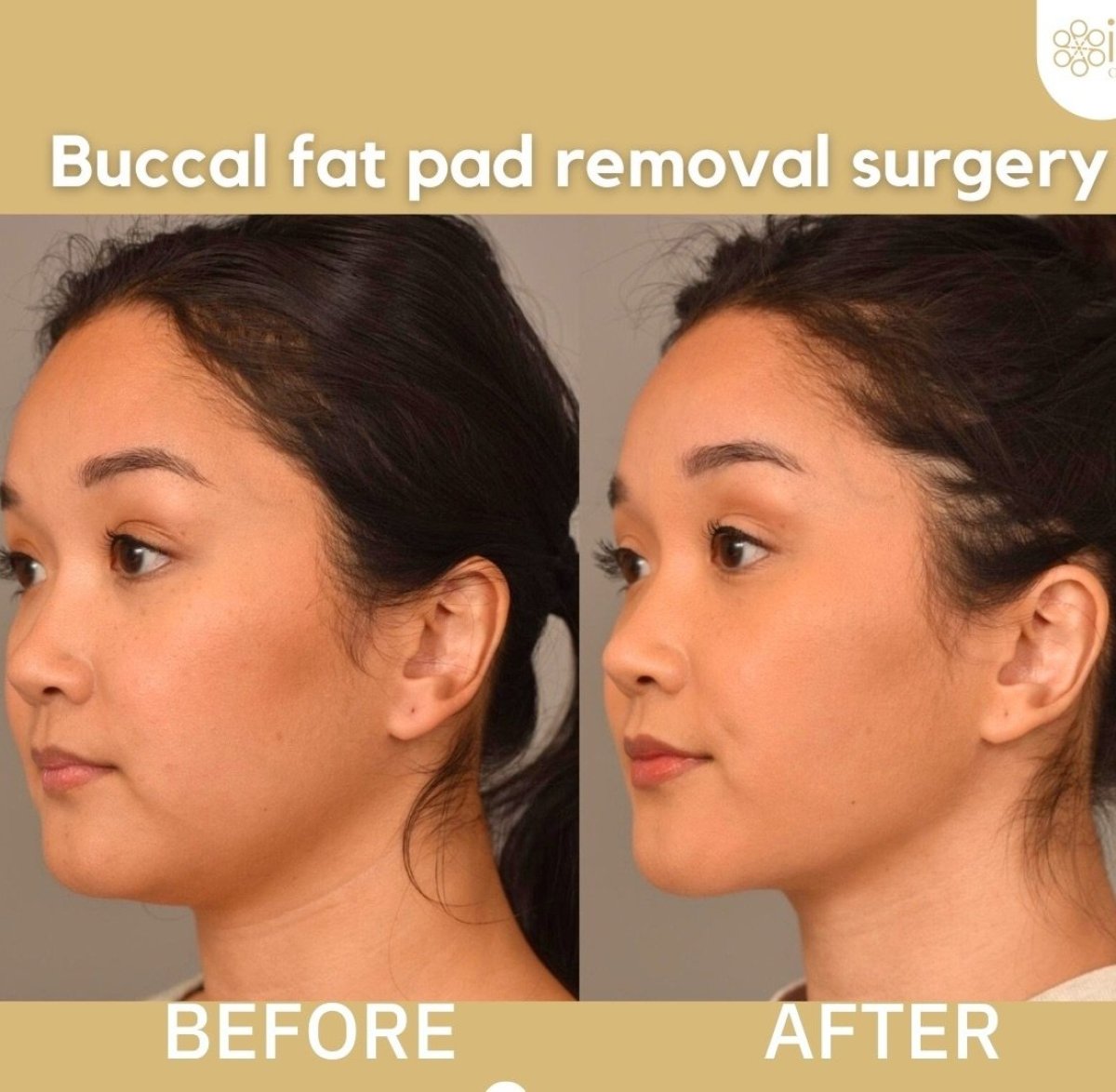Resultados antes y después de extracción de bolas de Bichat en ID Clinic Bangkok, rostro más delgado