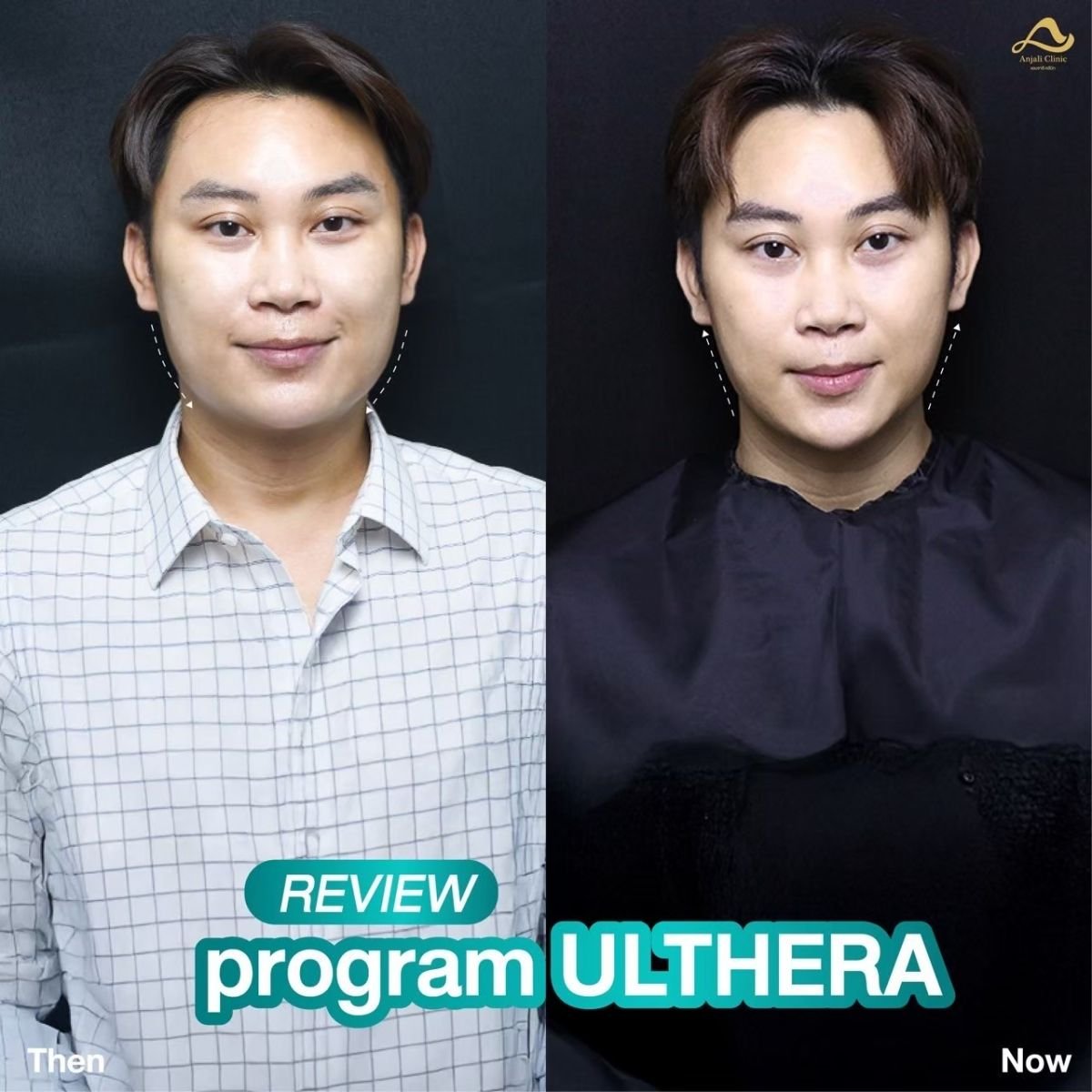 Efekty przed i po Ultherapy w Anjali Clinic, poprawa konturu twarzy