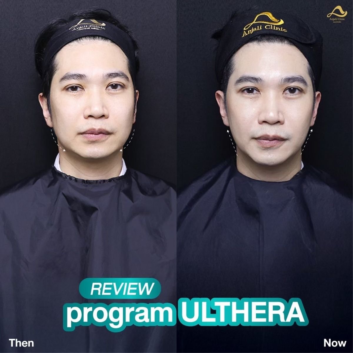Before and after Ultherapy results at Anjali Clinic – visible facial lifting and tightening