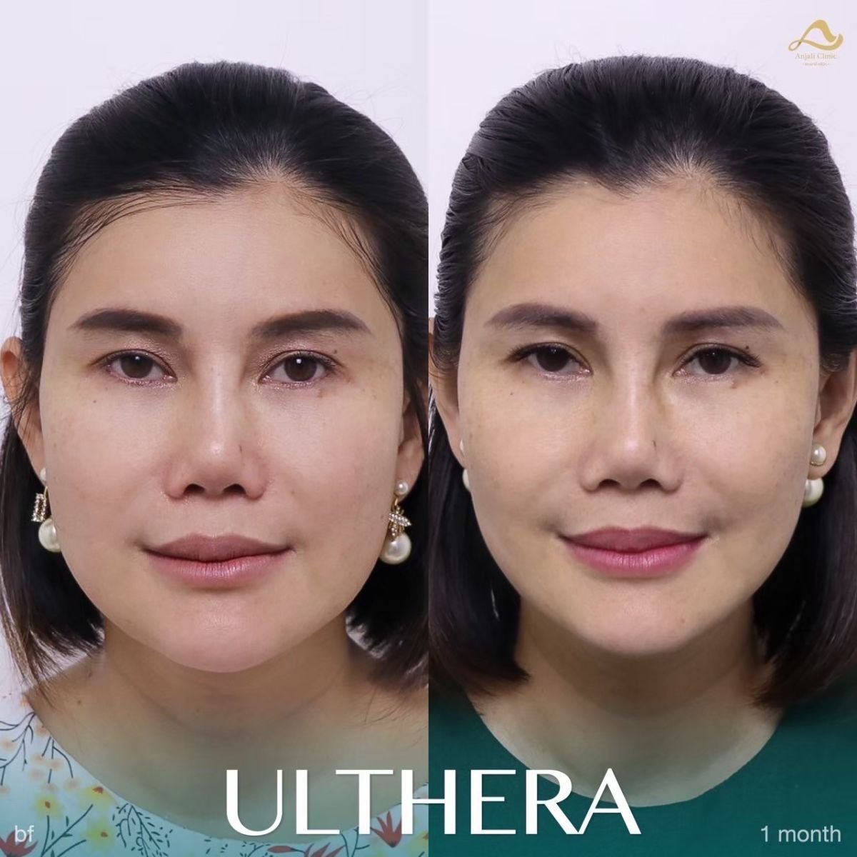 نتائج قبل وبعد علاج Ultherapy في عيادة Anjali – شد واضح للبشرة بعد شهر