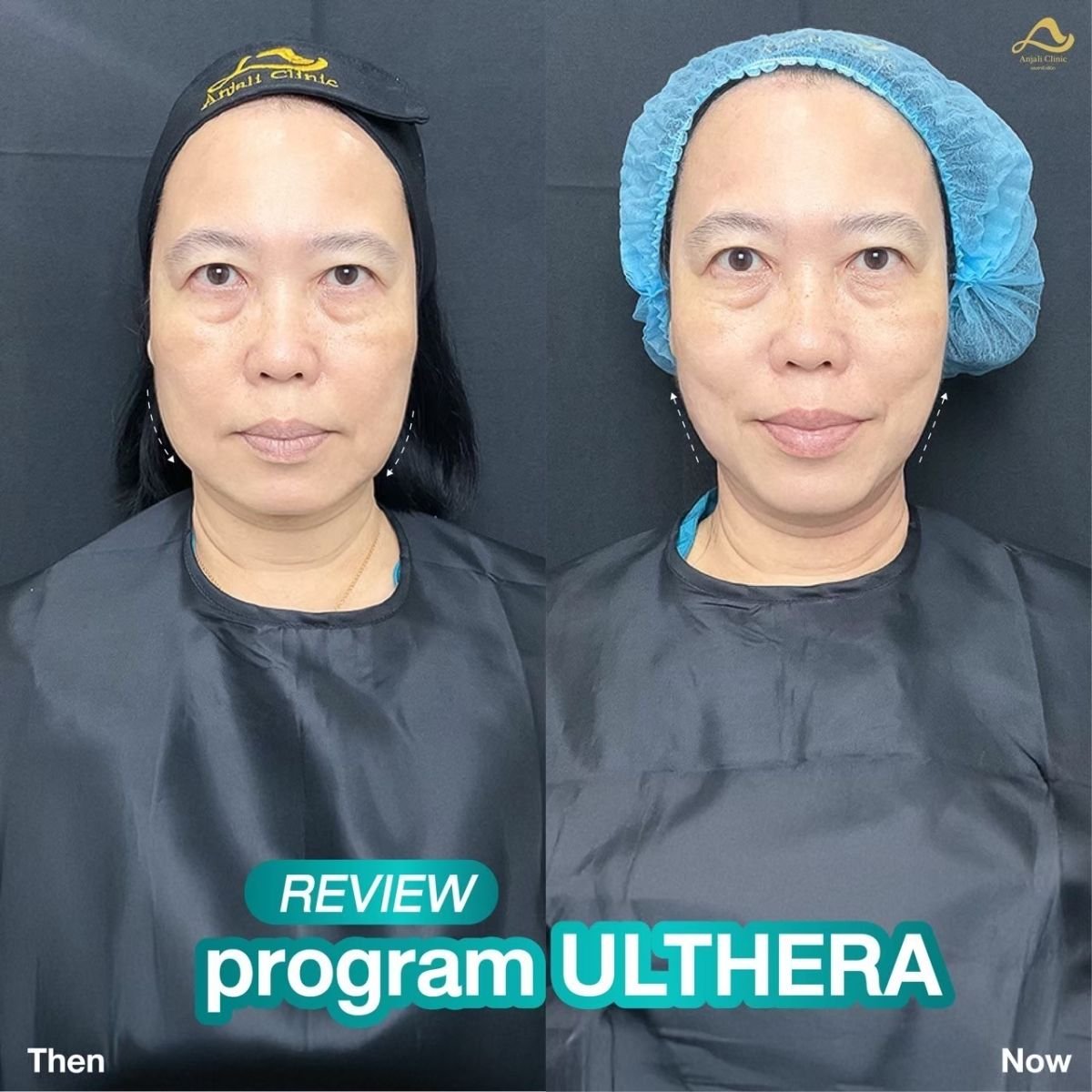 Before and after Ultherapy results at Anjali Clinic, facial skin tightening and lifting