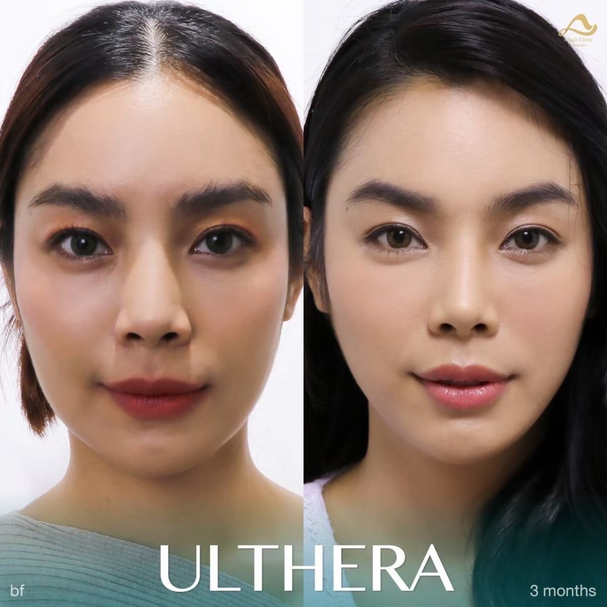 Résultats avant/après Ultherapy à la clinique Anjali – lifting et raffermissement du visage