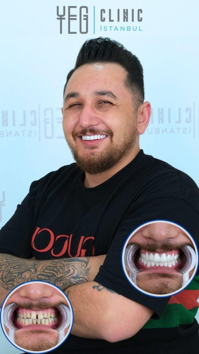 Before and after Lumineer results at YEG Clinic – smile makeover with whiter, even teeth