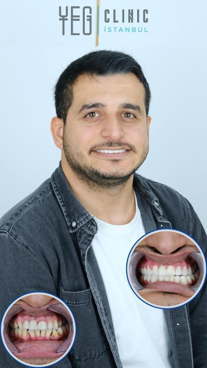 Before and after Lumineer results at YEG Clinic – improved smile and whiter teeth