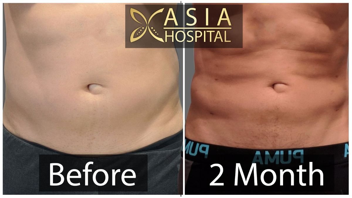 Результаты абдоминального этчинга до и после в Asia Cosmetic Hospital, видимые кубики