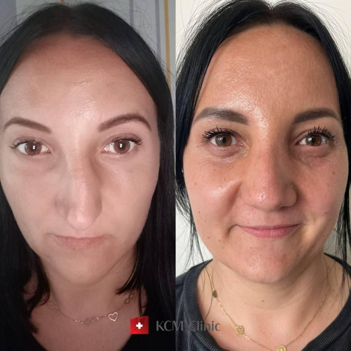 Before and after septoplasty results at KCM Clinic, improved nasal symmetry and breathing