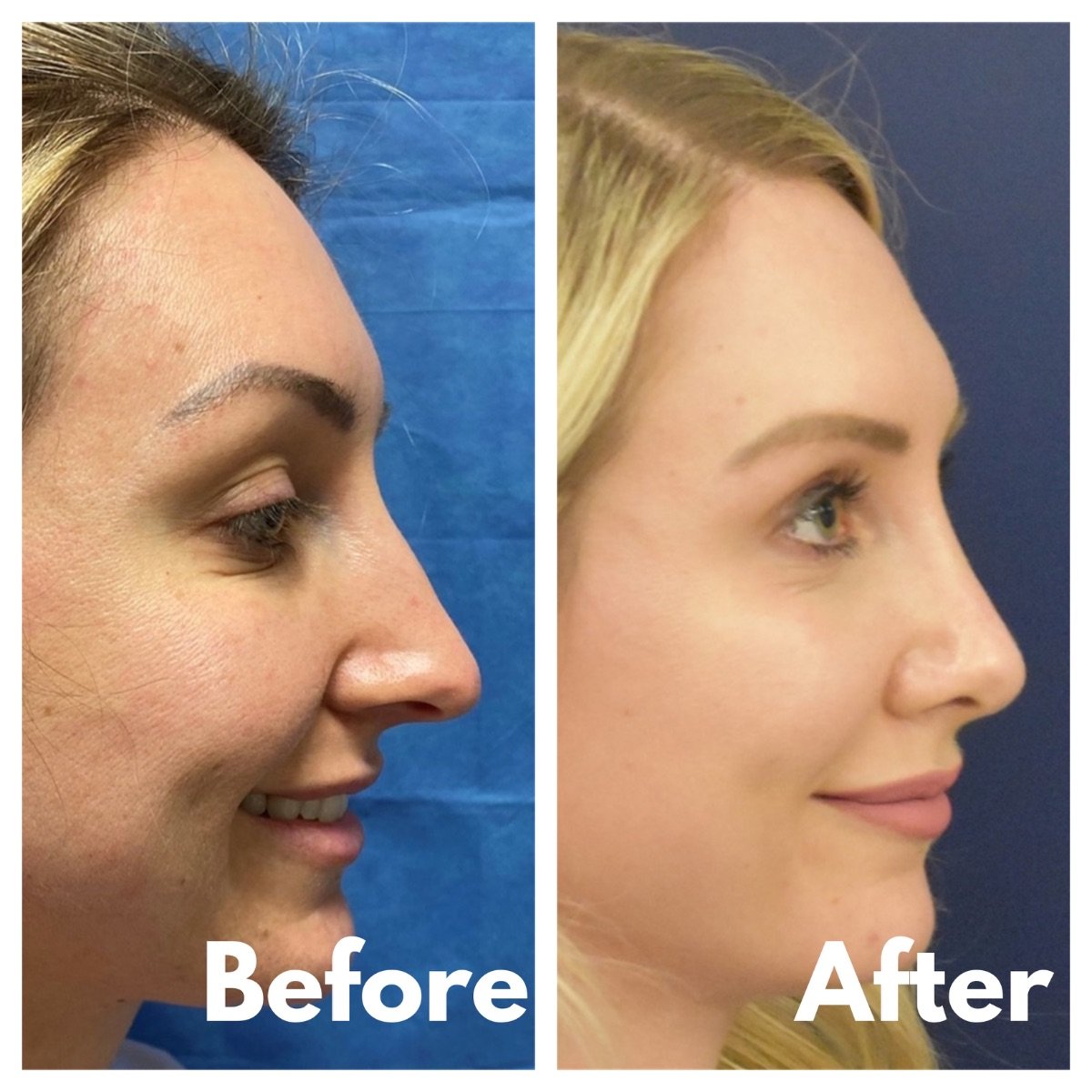 Before and after revision rhinoplasty results at Estexper Clinic, improved nose profile