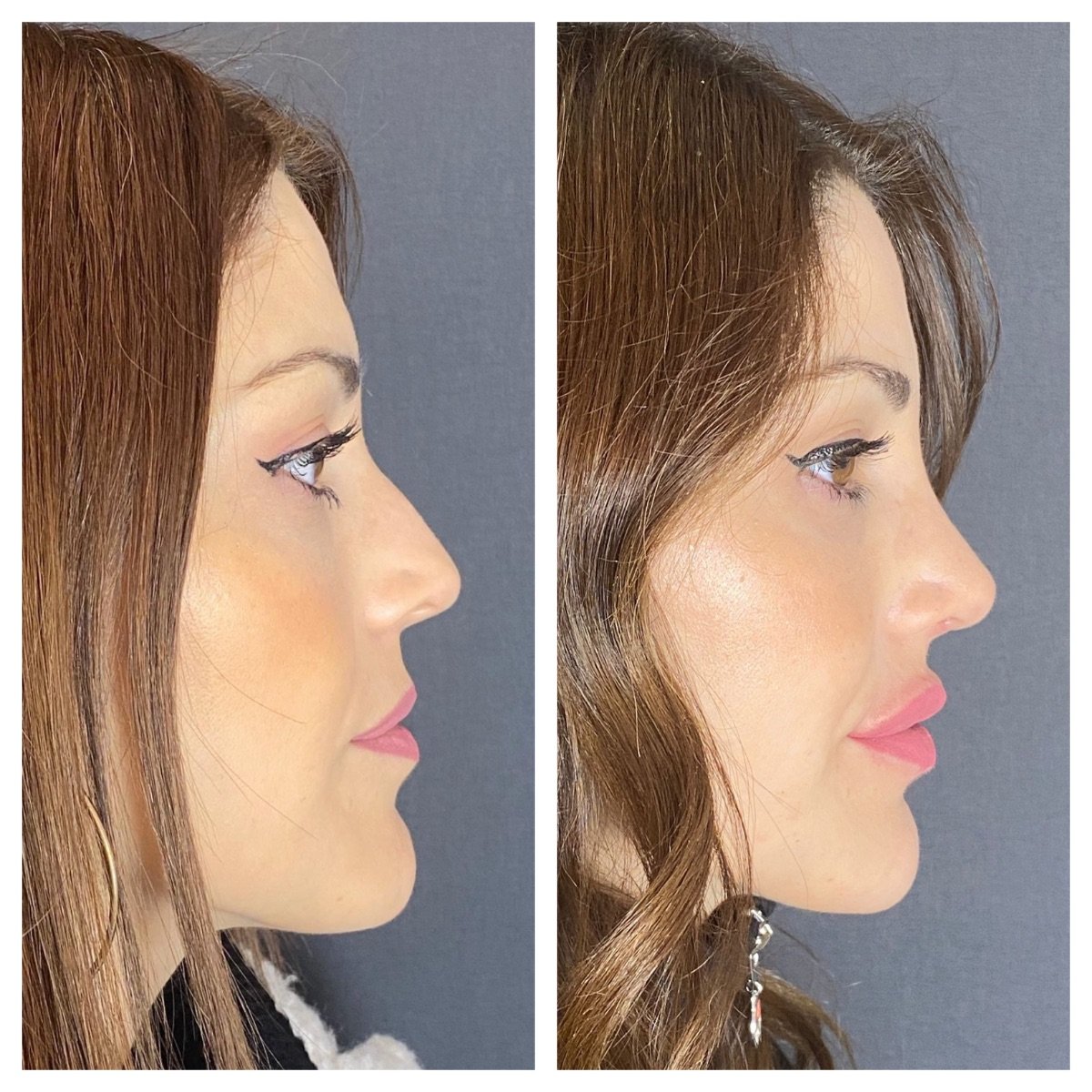 Before and after revision rhinoplasty results at Estexper Clinic, improved nose profile