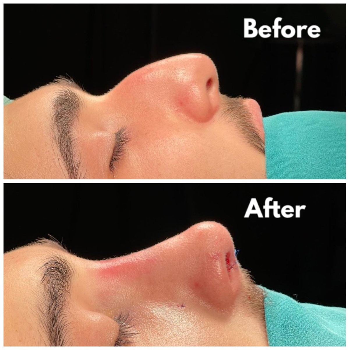 Before and after revision rhinoplasty results at Estexper Clinic, improved nose shape
