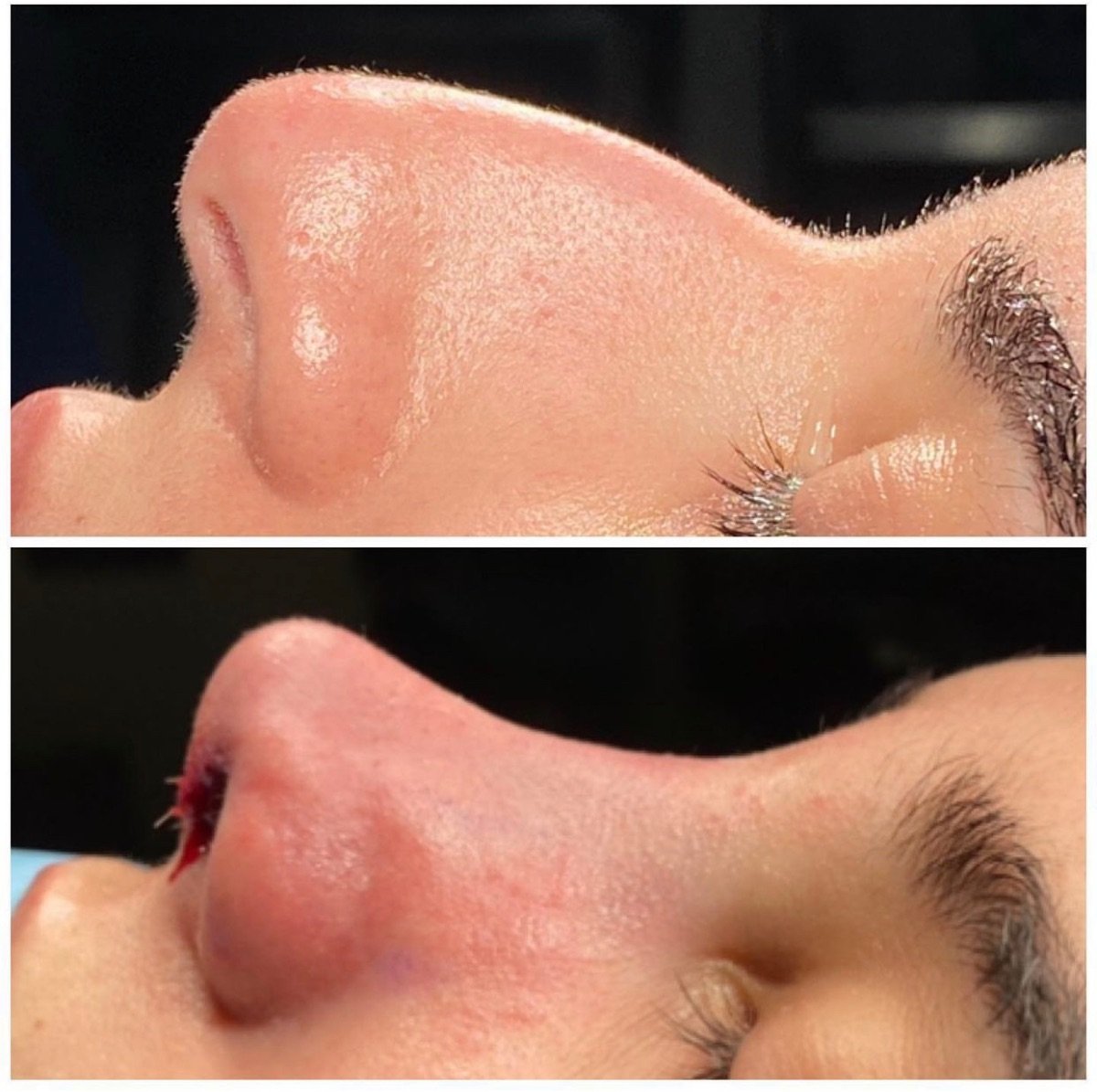نتيجة قبل وبعد عملية تجميل الأنف التصحيحية في Estexper Clinic، تحسين شكل الأنف