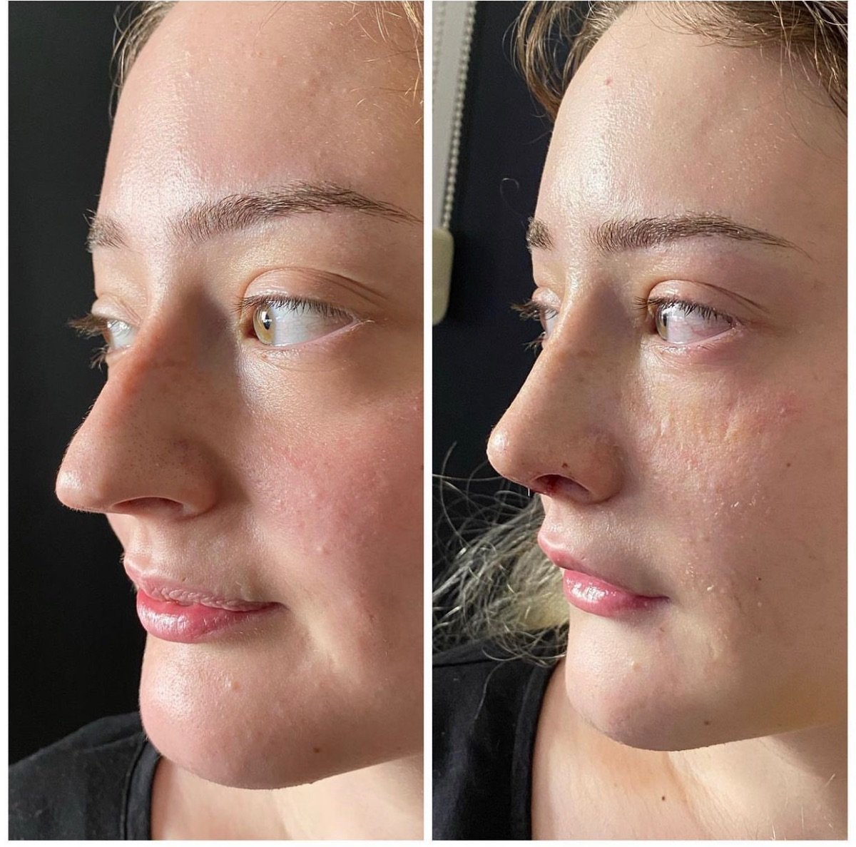 Before and after revision rhinoplasty results at Estexper Clinic, improved nose shape
