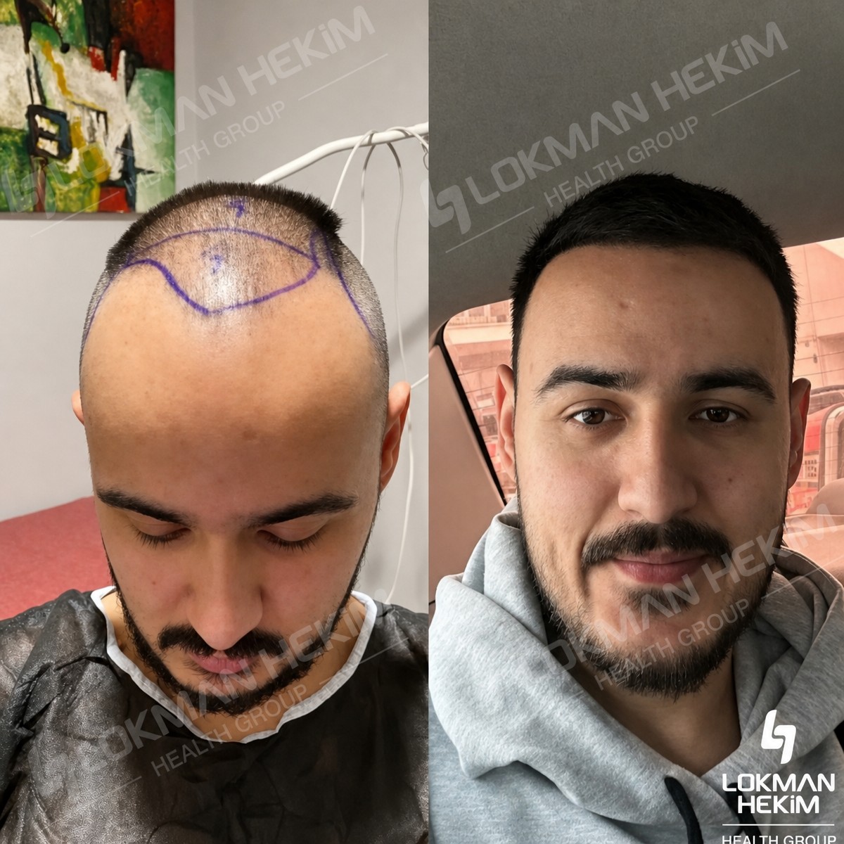 Before and after hair transplant results at Lokman Hekim Istanbul Hospital, restored hairline