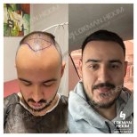 صور قبل وبعد زراعة الشعر للدكتور 