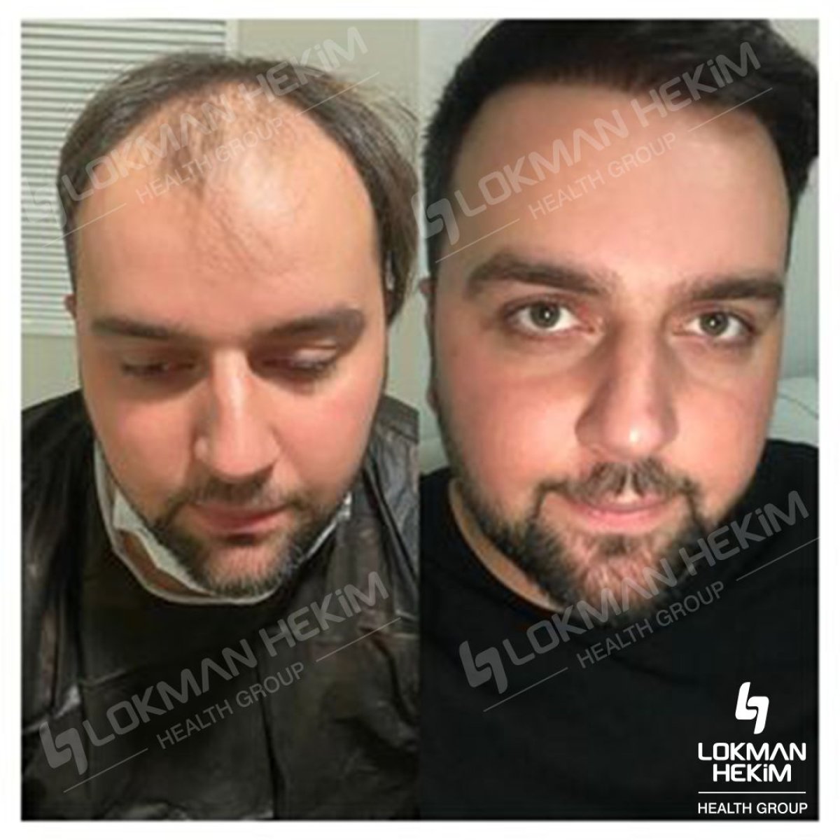 نتائج زراعة الشعر قبل وبعد في مستشفى لوكمان حكيم إسطنبول، استعادة خط الشعر