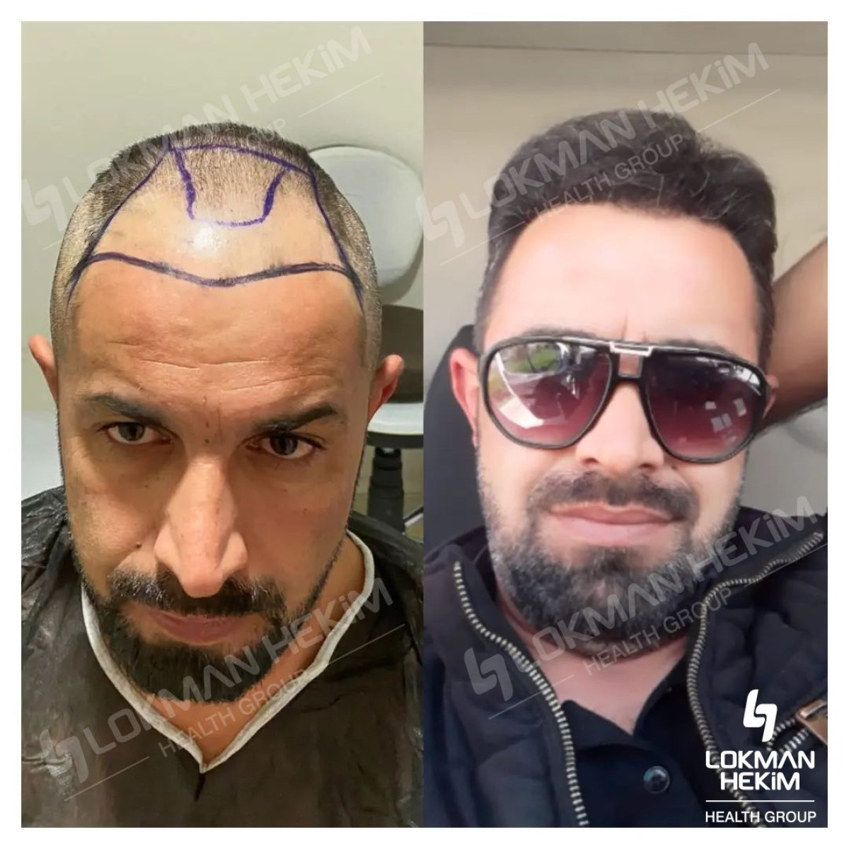 نتائج زراعة الشعر قبل وبعد في مستشفى لقمان حكيم إسطنبول، استعادة خط الشعر