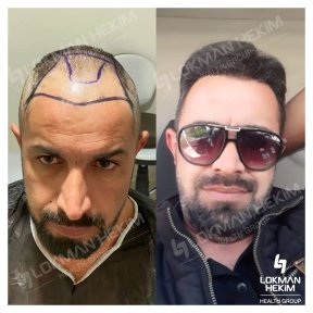 Premium Hair transplant (2000-4500 Grafts) All Included - photo 4