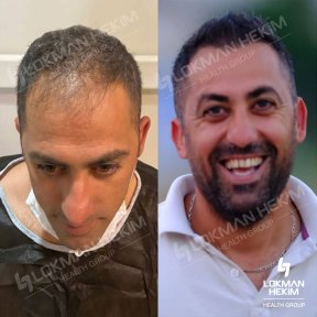 Premium Hair transplant (2000-4500 Grafts) All Included - photo 6