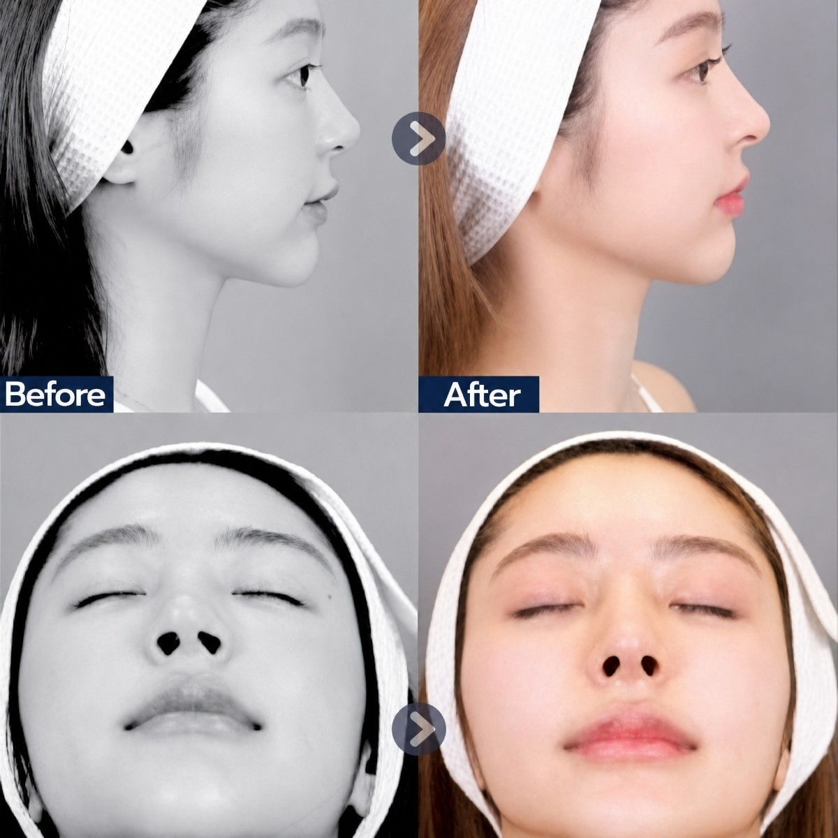 Resultados de rinoplastia antes y después en Dr. Chen Clinic, nariz de aspecto natural