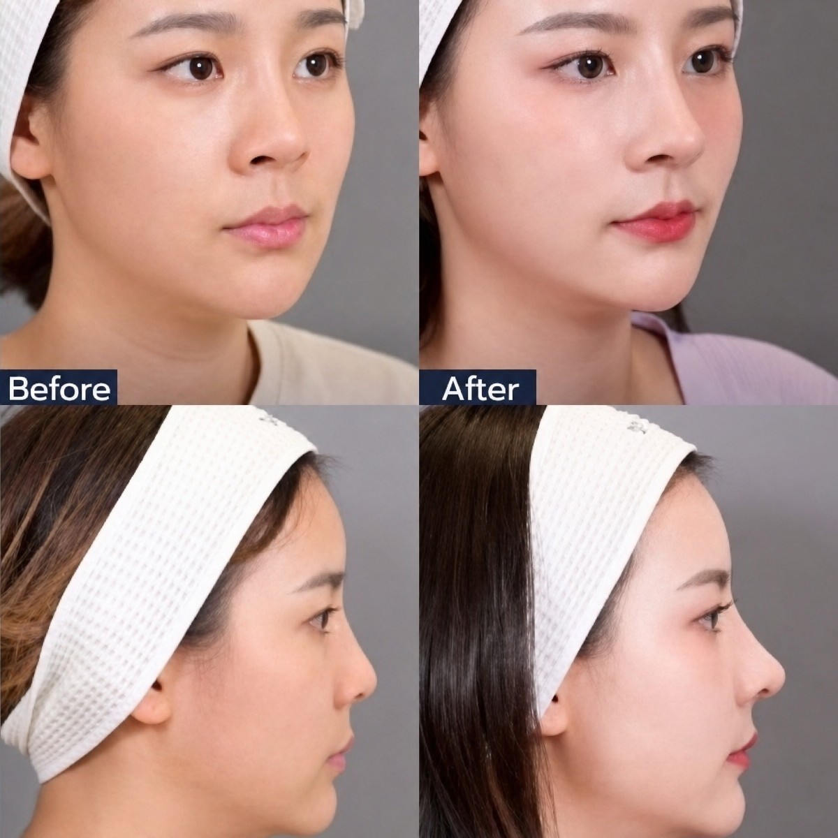 Résultats avant et après rhinoplastie à la Dr. Chen Clinic, remodelage nasal naturel