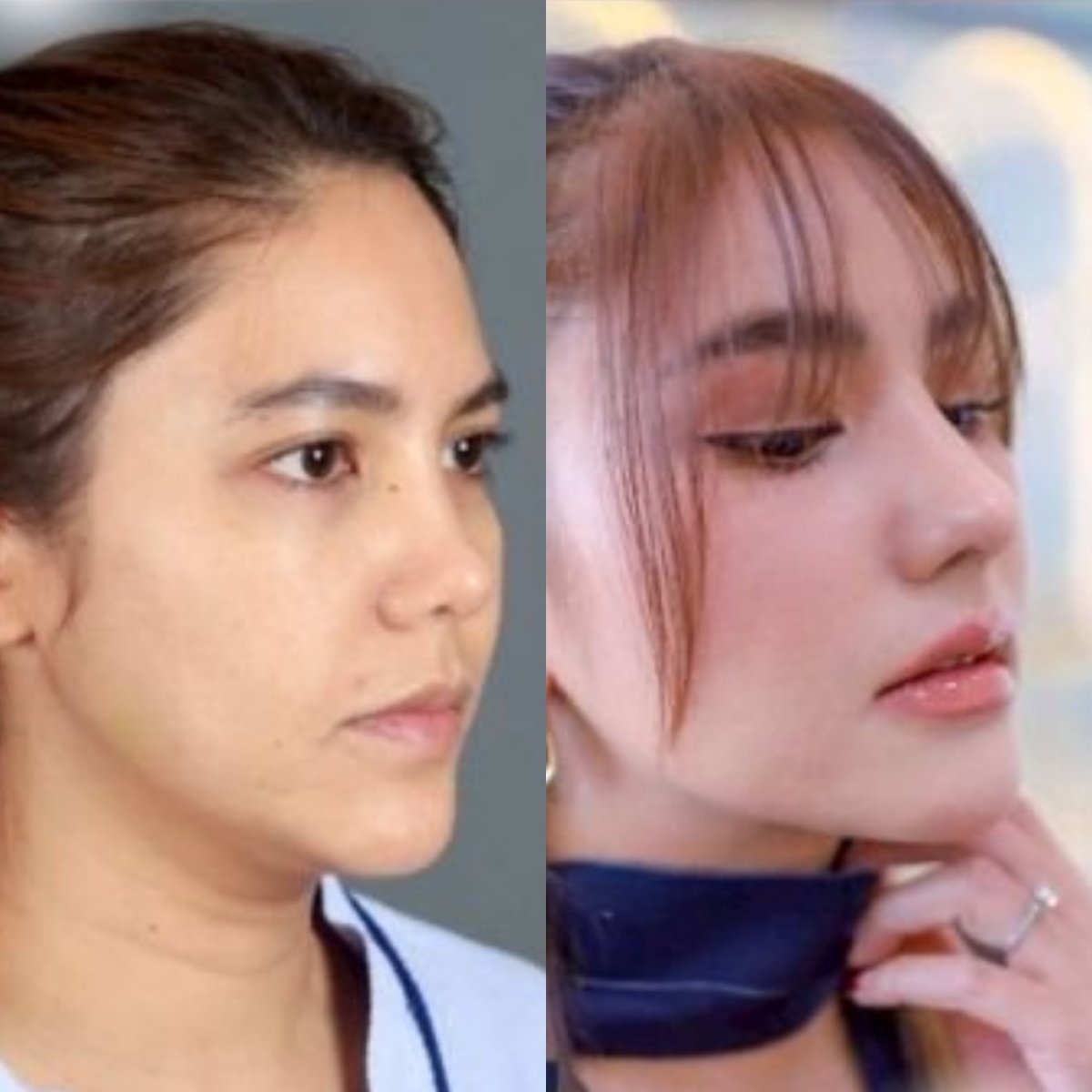 Resultados de rinoplastia antes y después en Dr. Chen Clinic, nariz de aspecto natural