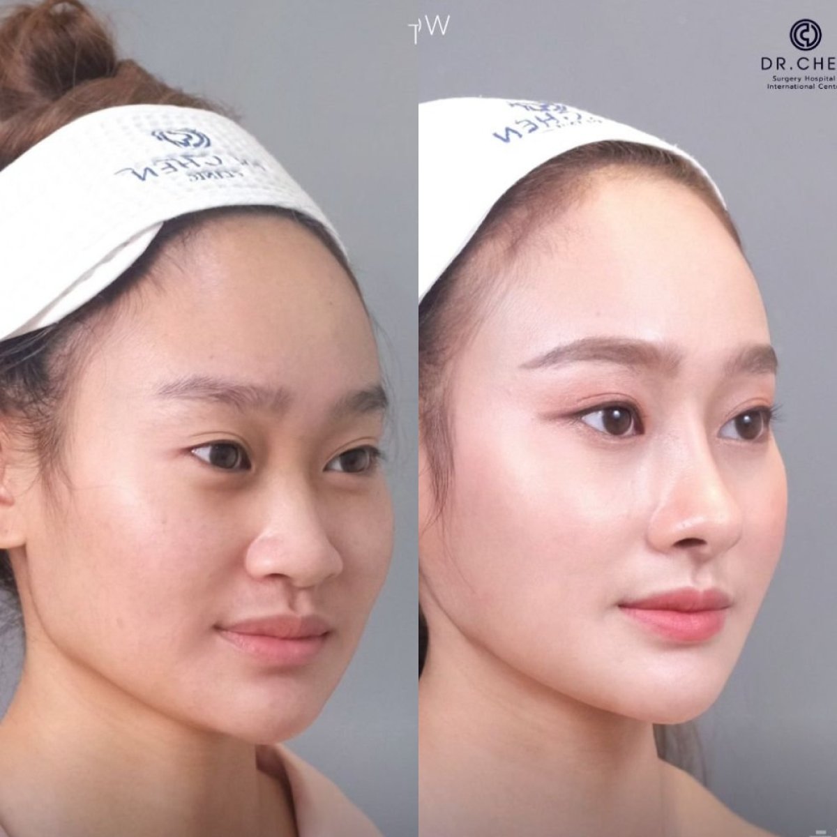 Before and after rhinoplasty results at Dr. Chen Clinic, nose reshaping with natural look