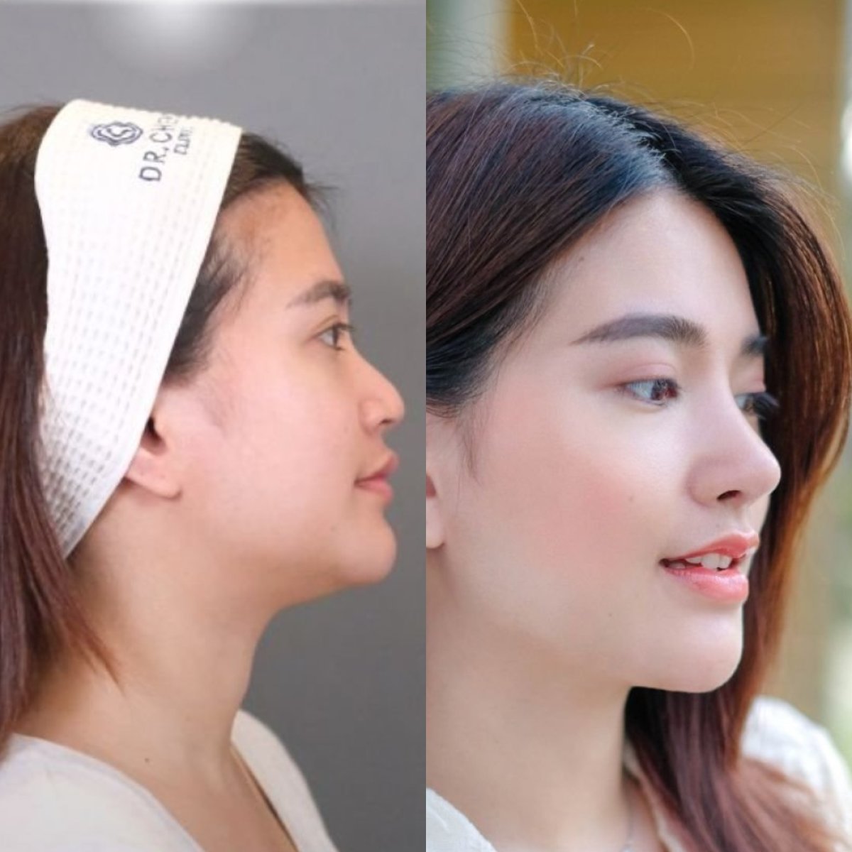 Resultados de rinoplastia antes y después en Dr. Chen Clinic, mejora de forma y perfil nasal