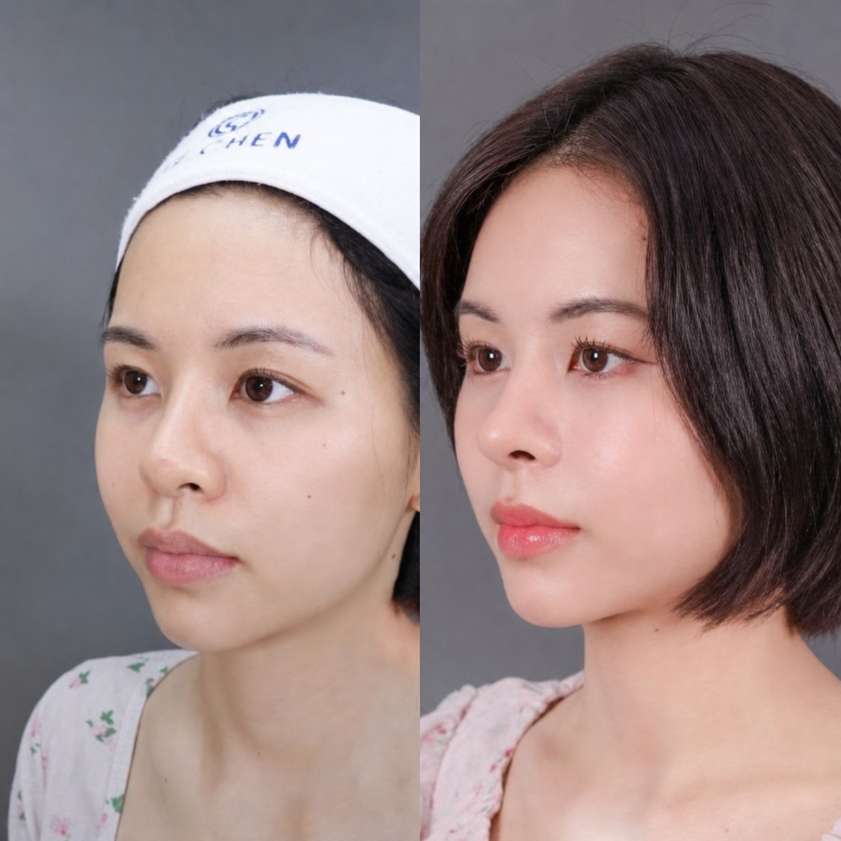 Resultados de rinoplastia antes y después en Dr. Chen Clinic, nariz de aspecto natural