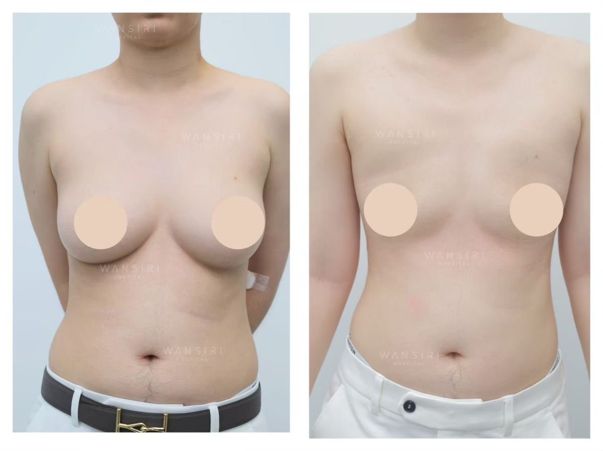 Resultados de top surgery antes y después en Wansiri Hospital, masculinización de pecho