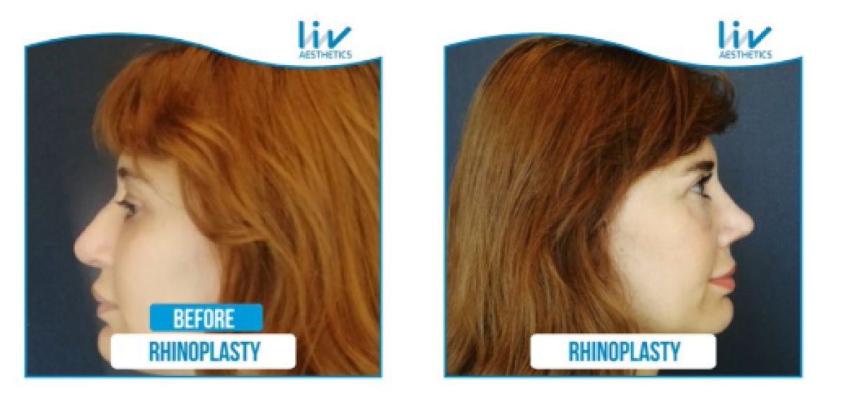 Результаты ринопластики до и после в Liv Hospital Vadistanbul, улучшение формы носа