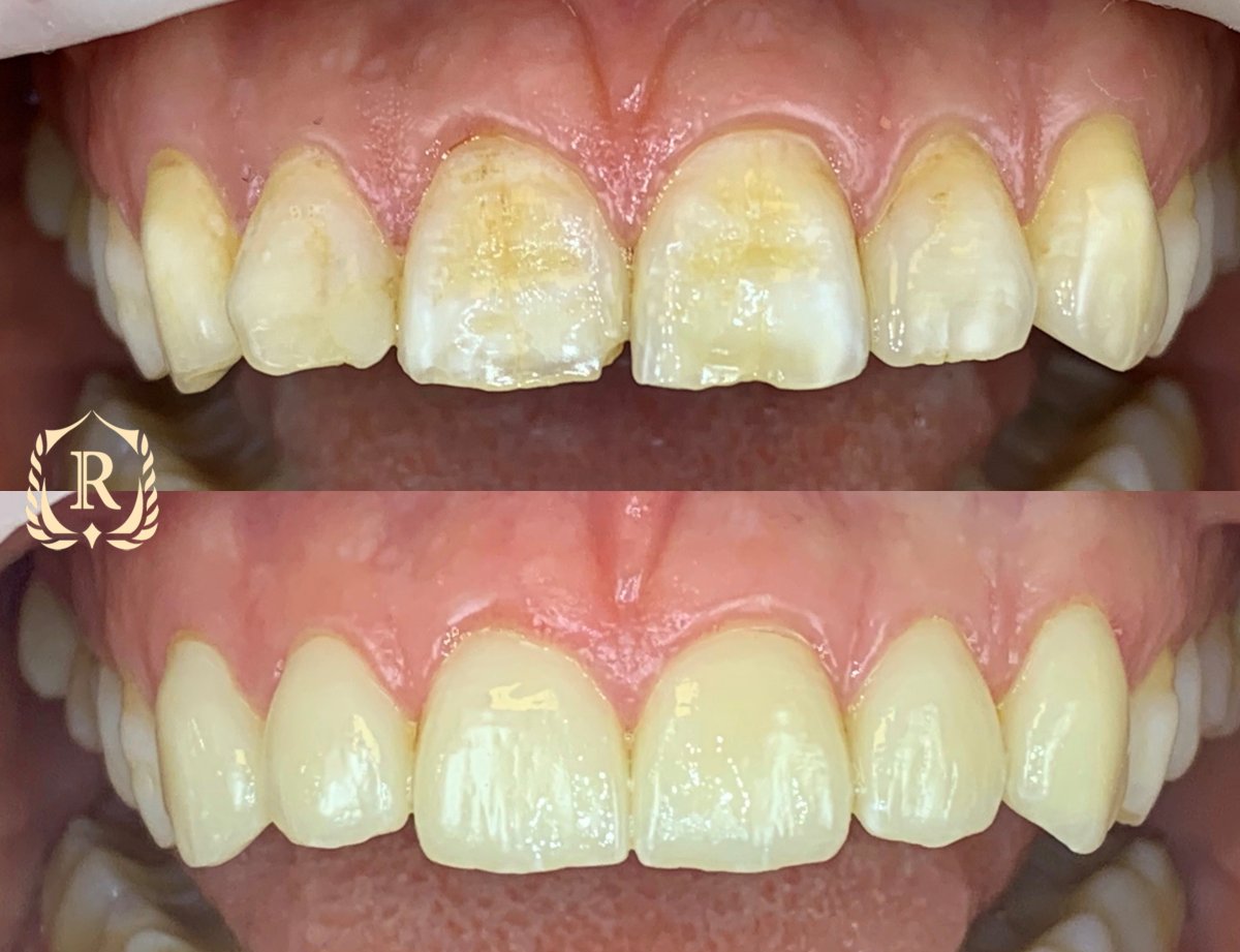 Результати зміни посмішки до і після в Rosental Dental – покращення кольору та форми зубів