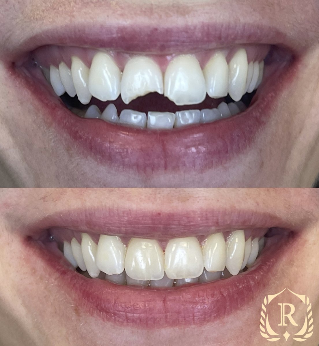 Antes y después de smile makeover en Rosental Dental – restauración de dientes astillados