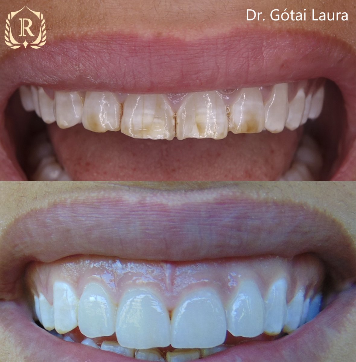 Antes y después de smile makeover en Rosental Dental – mejor color y alineación dental