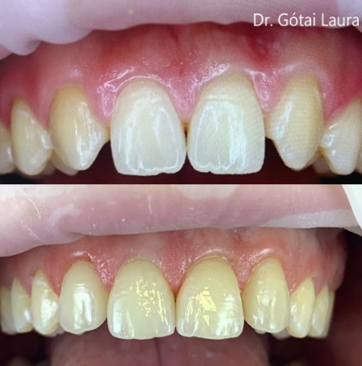 Antes y después de smile makeover en Rosental Dental: mejora en forma dental y encías