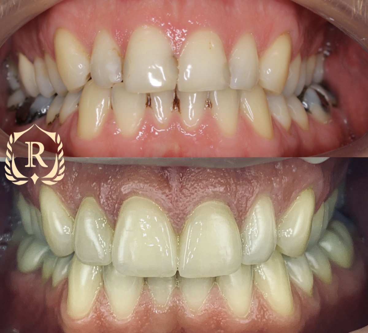 Vorher-nachher-Ergebnis Smile Makeover bei Rosental Dental – bessere Zahnfarbe und Ausrichtung