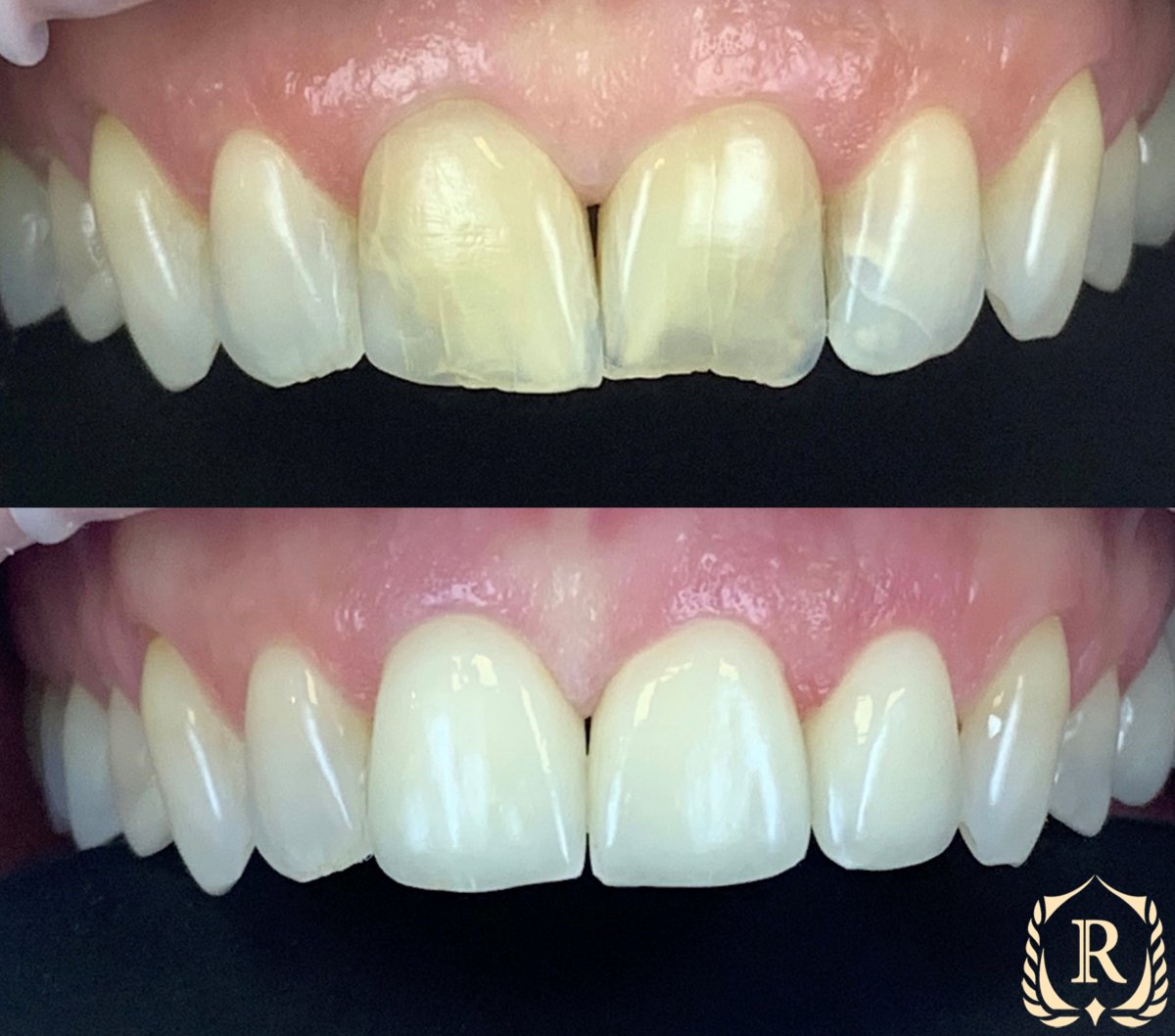 Antes y después de smile makeover en Rosental Dental: mejor color y alineación dental