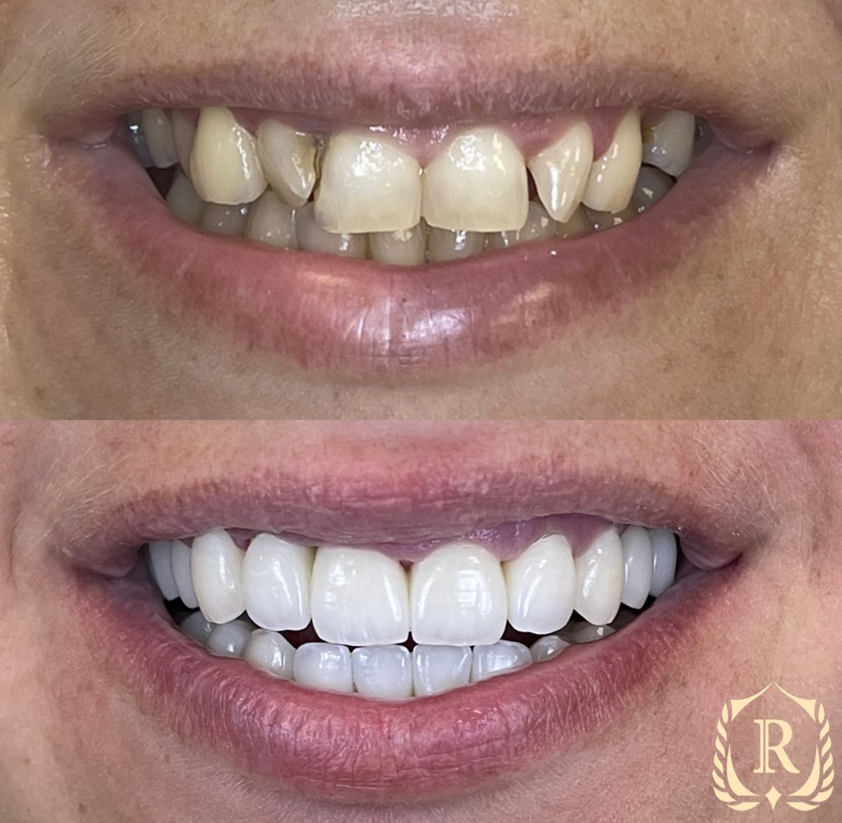 Результати до і після зміни усмішки в Rosental Dental – вирівнювання та відтінок зубів