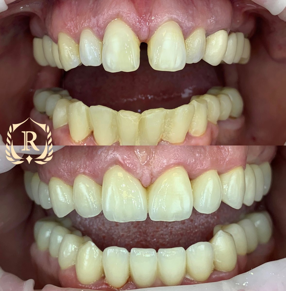 Avant/après smile makeover chez Rosental Dental – alignement et fermeture des espaces dentaires