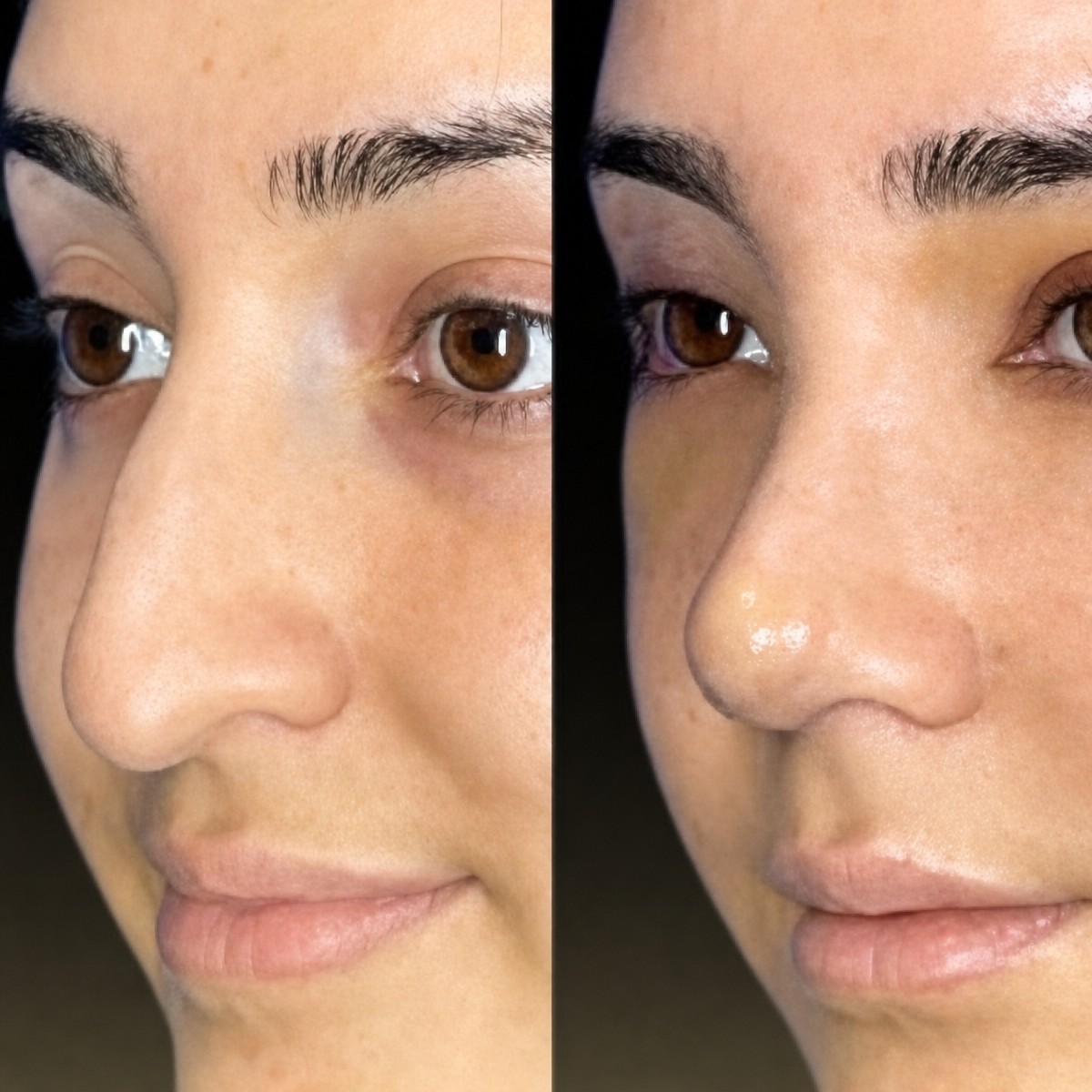 Before and after ultrasonic rhinoplasty result at Memorial Şişli Hospital, nose reshaping
